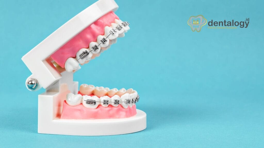 gigi tidak bisa pasang behel