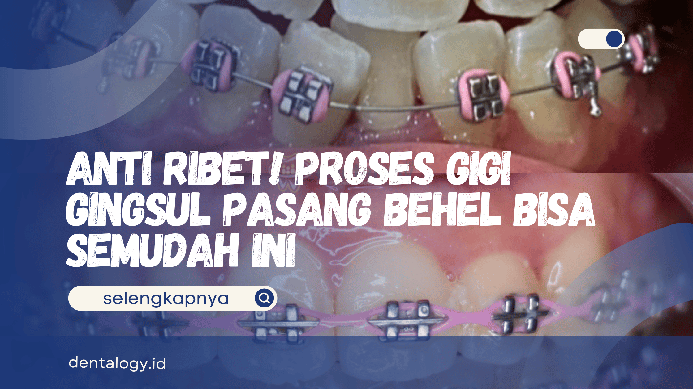 Gigi Gingsul Pasang Behel