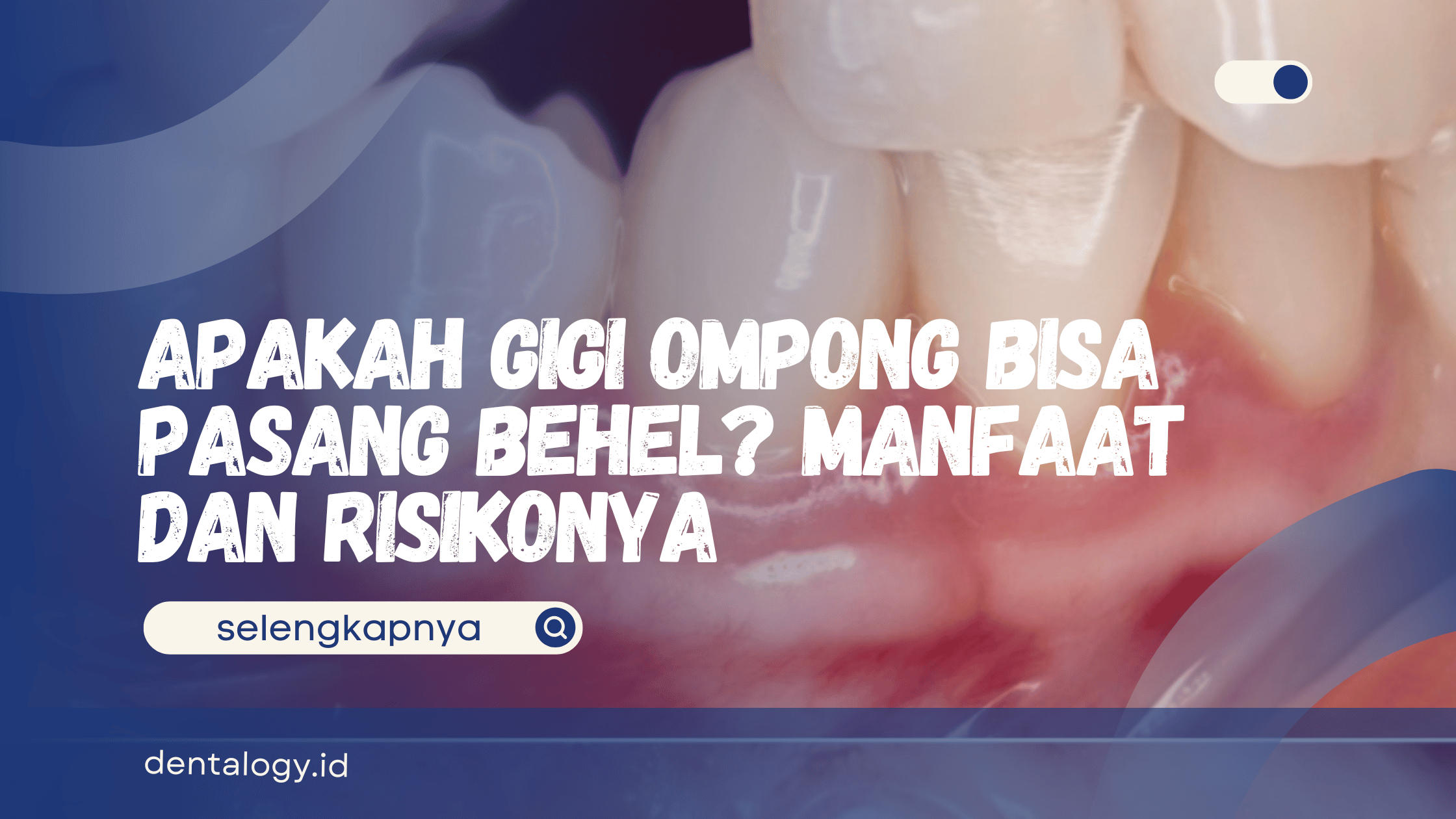 Apakah Gigi Ompong Bisa Pasang Behel