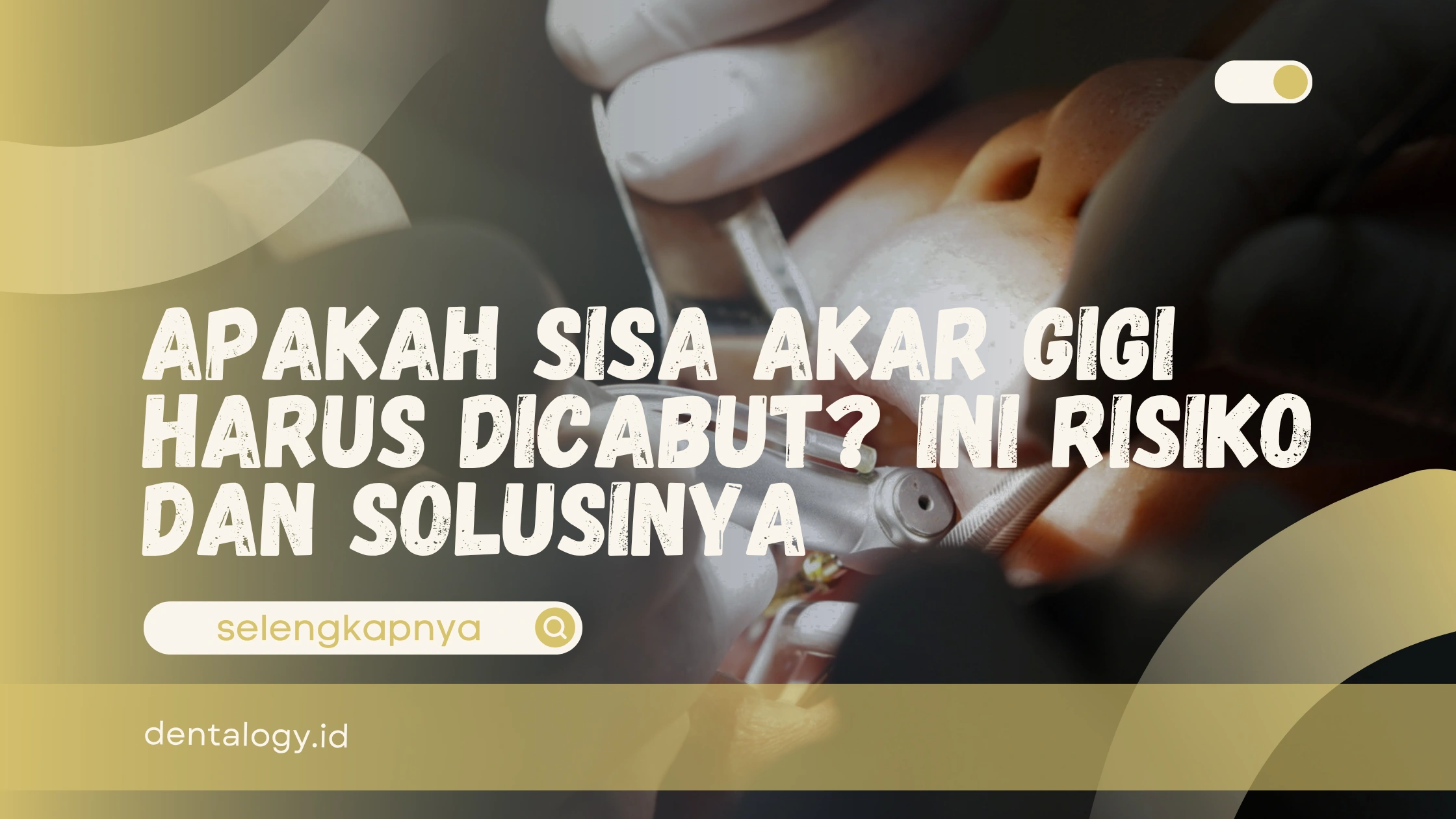 Apakah Sisa Akar Gigi Harus Dicabut