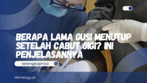 Berapa Lama Gusi Menutup Setelah Cabut Gigi
