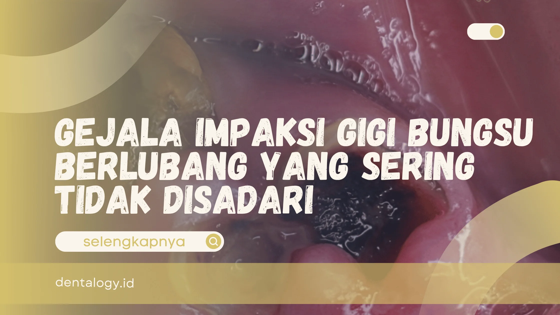 Impaksi gigi bungsu berlubang