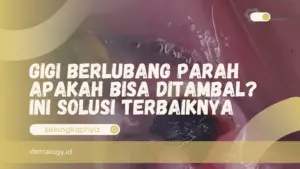 Gigi Berlubang Parah Apakah Bisa Ditambal