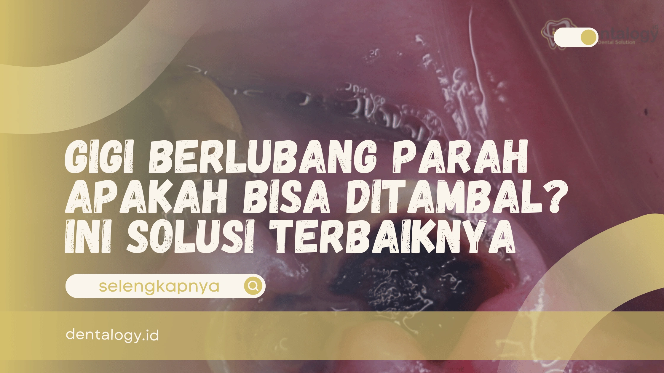 Gigi Berlubang Parah Apakah Bisa Ditambal