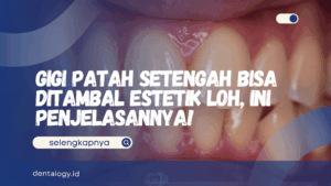Gigi Patah Setengah Bisa Ditambal