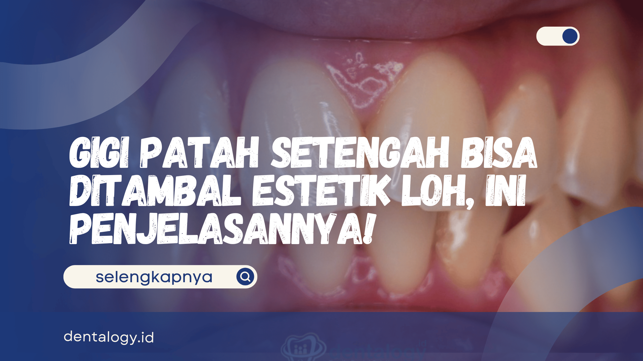 Gigi Patah Setengah Bisa Ditambal