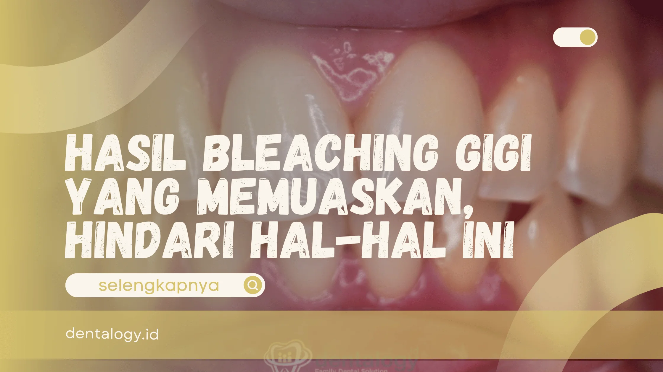 hasil bleaching gigi