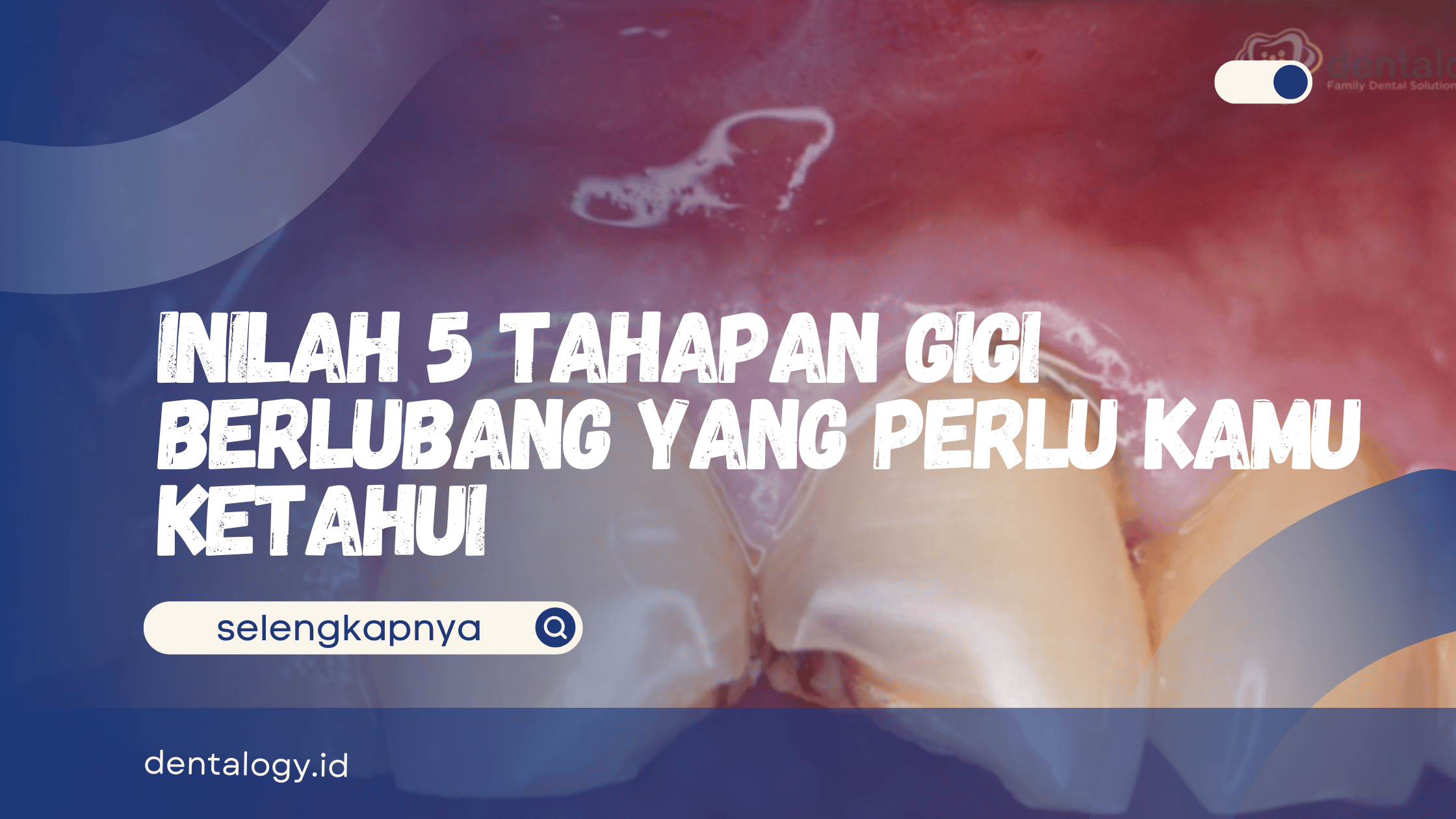 Tahapan Gigi Berlubang