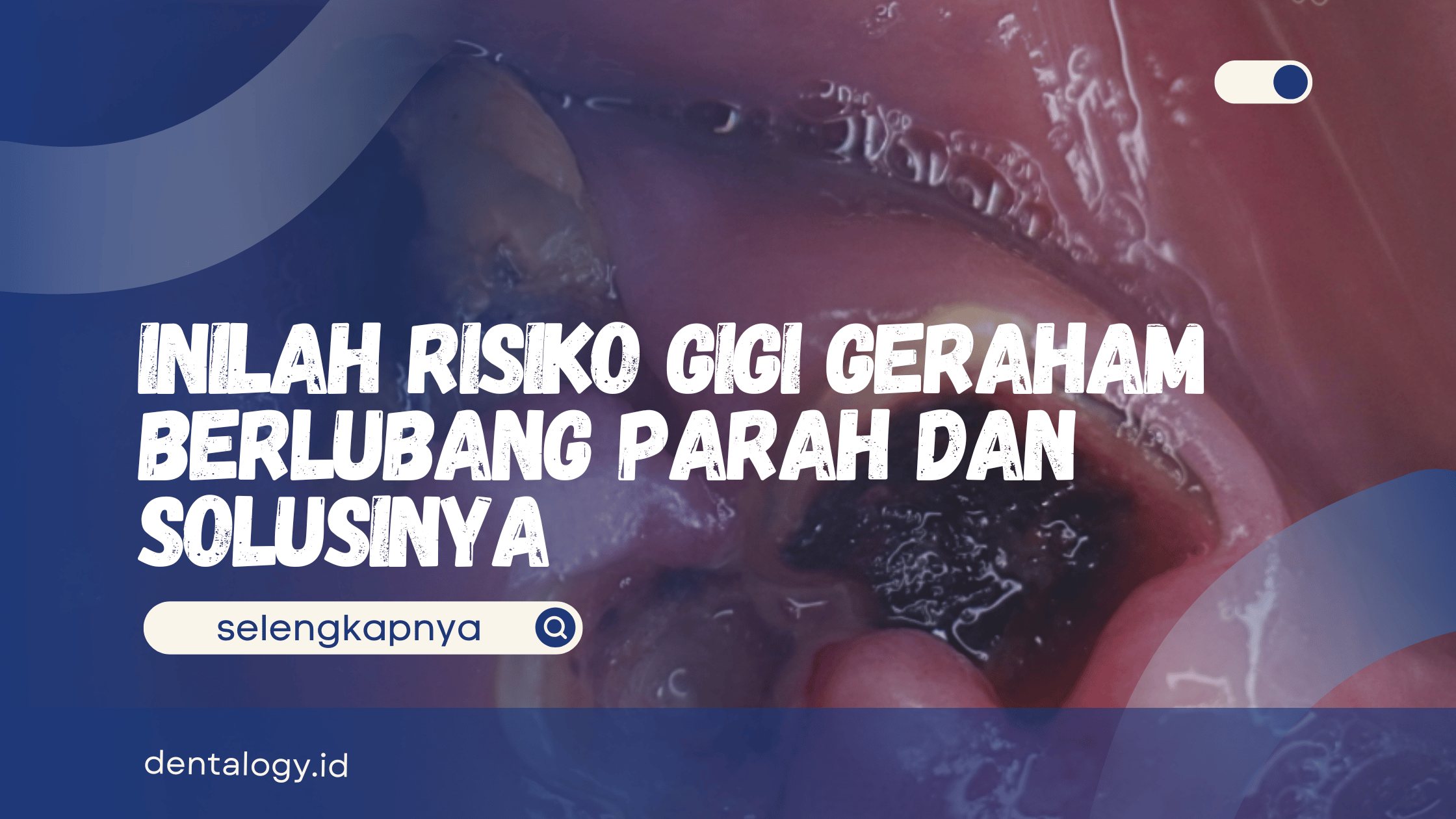 Gigi Geraham Berlubang Parah