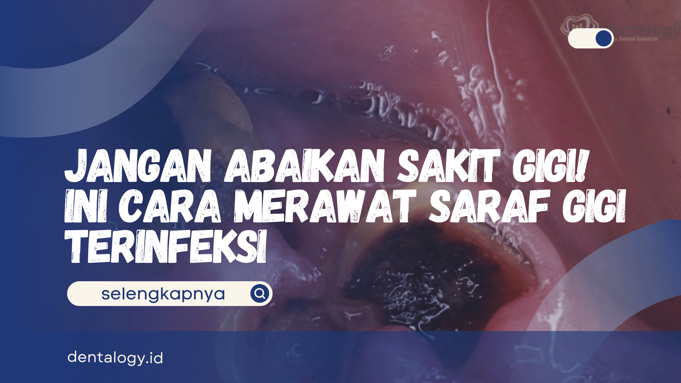 Cara Merawat Saraf Gigi