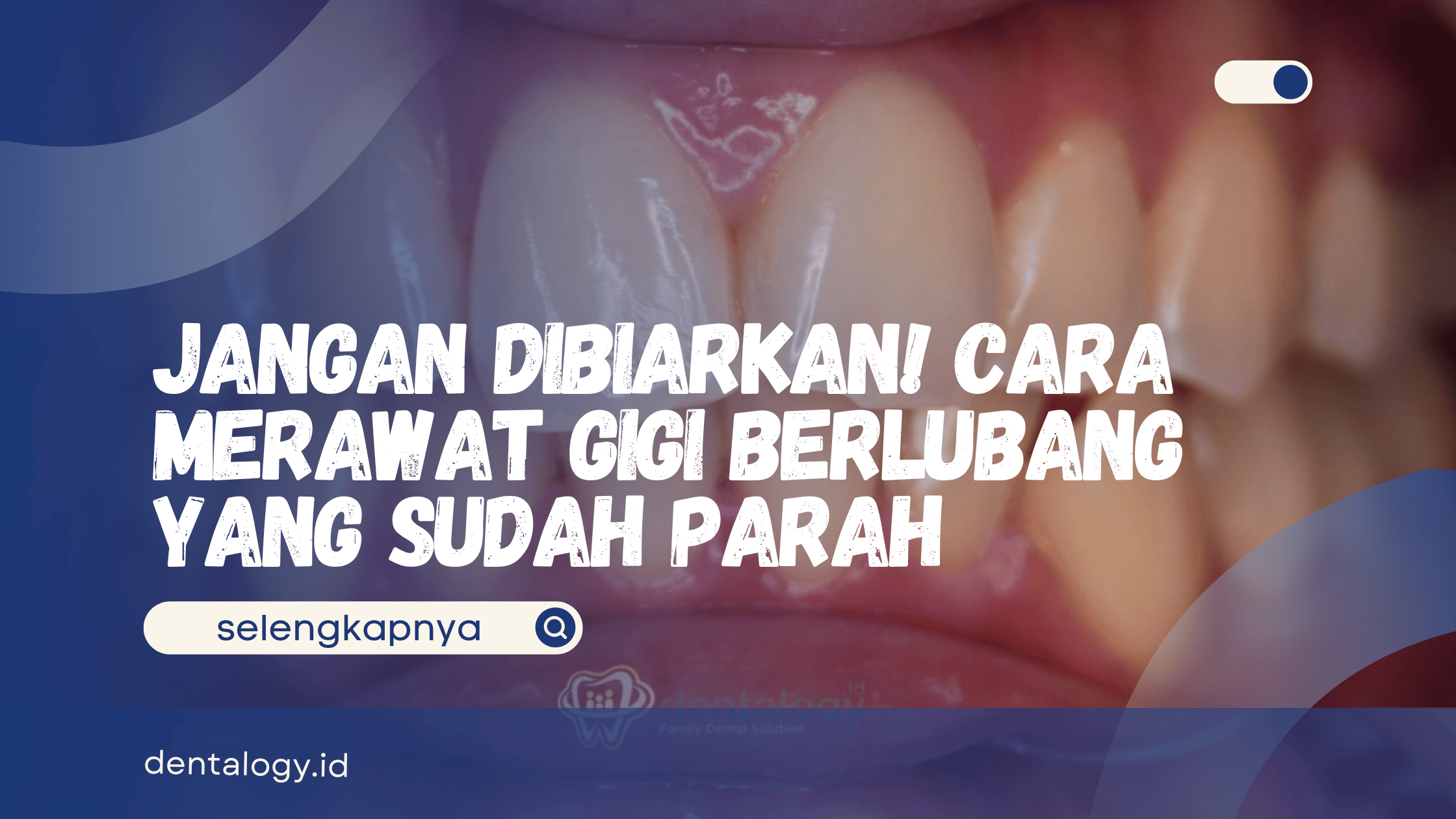 Cara Merawat Gigi Berlubang yang Sudah Parah