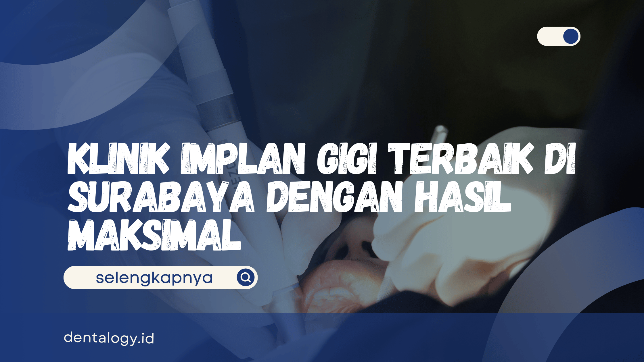 Implan Gigi Terbaik di Surabaya