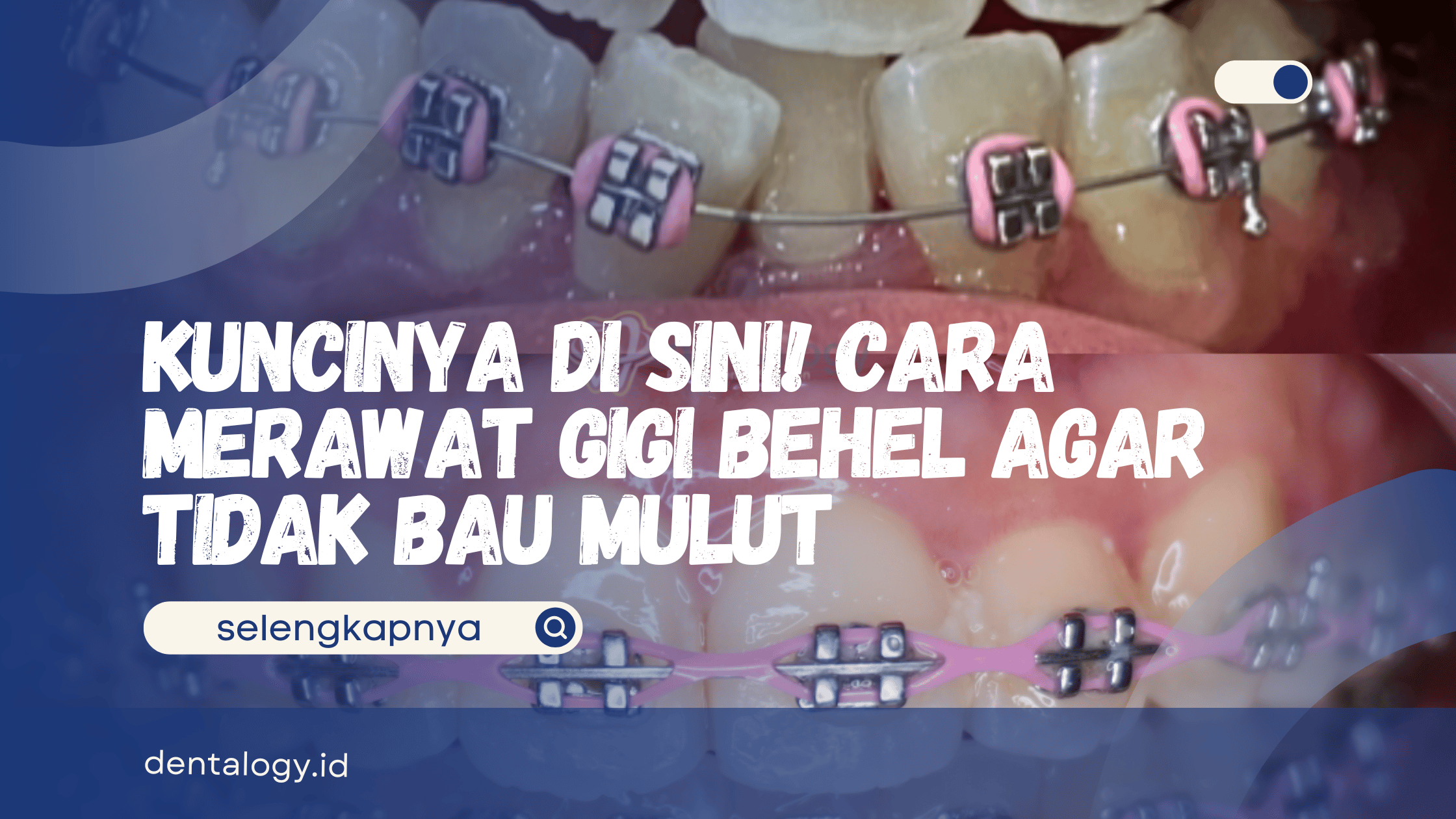 Cara Merawat Gigi Behel Agar Tidak Bau Mulut