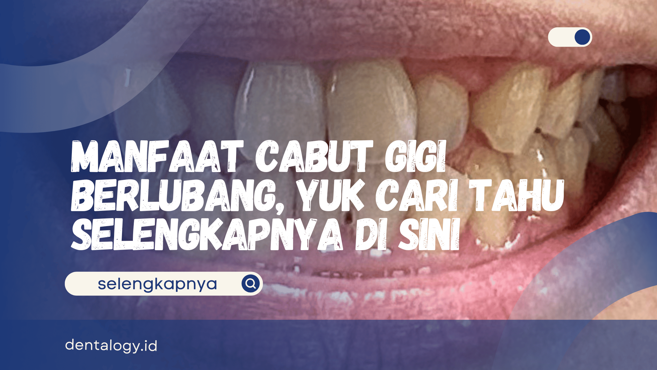 Cabut Gigi Berlubang