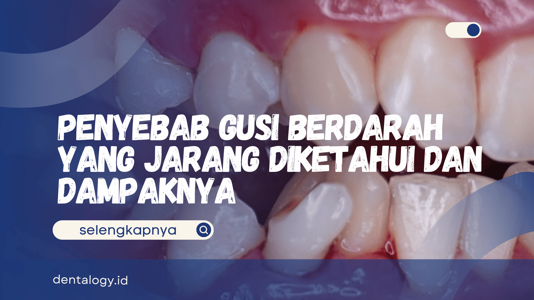 Penyebab Gusi Berdarah