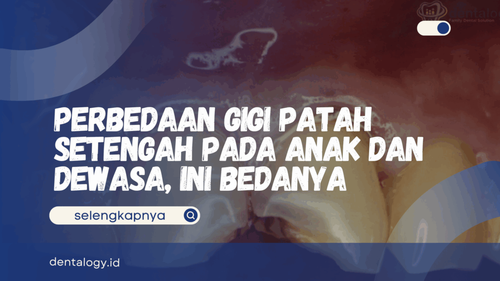 Gigi Patah Setengah