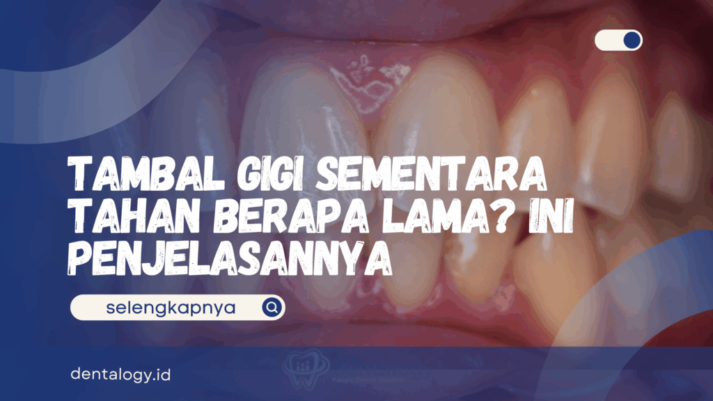 Tambal Gigi Sementara Tahan Berapa Lama