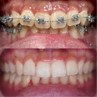 Behel damon surabaya